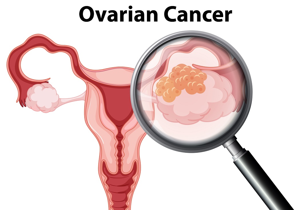 Ovarian Cancer